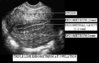 images%5Ctriplelineendometrium.jpg