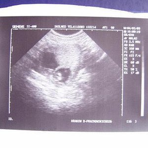 Nasze dwa maleństwa - zakończenie 12 tygodnia ciąży :)