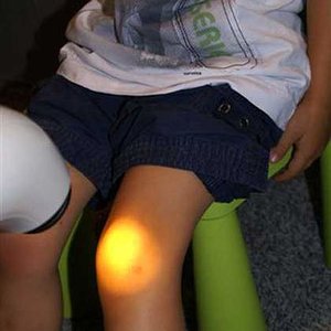 naświetlanie kolana
